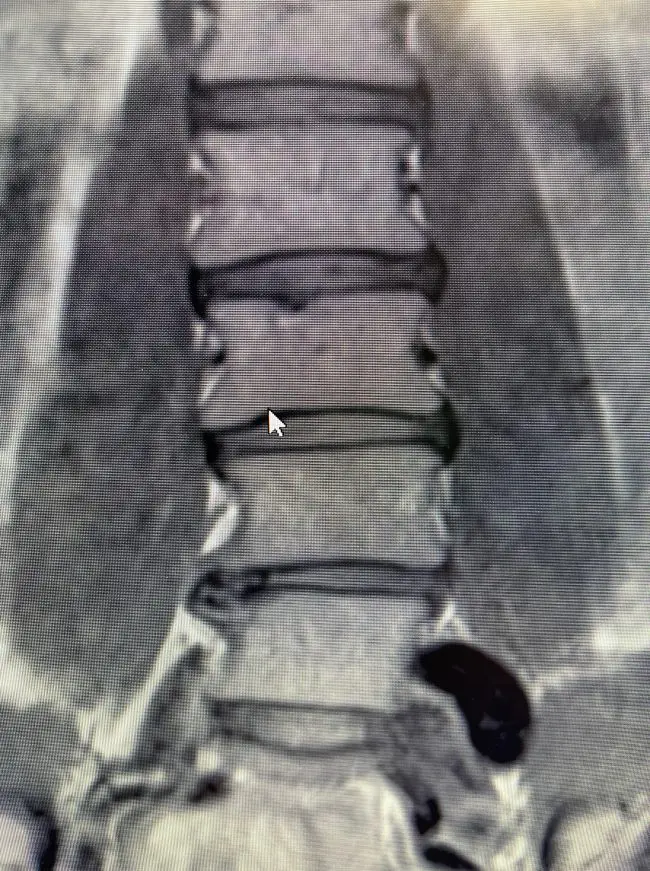 MRI scan showing the lumbar spine with intervertebral discs and vertebrae clearly visible. A cursor is pointing at the third vertebra from the top, a critical spot often addressed in Ring Dinger treatments popular in Seattle, Washington. Sports Medicine Northwest - West Seattle Chiropractic Clinic