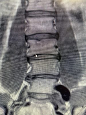 Dr. Pond's Lumbar mri