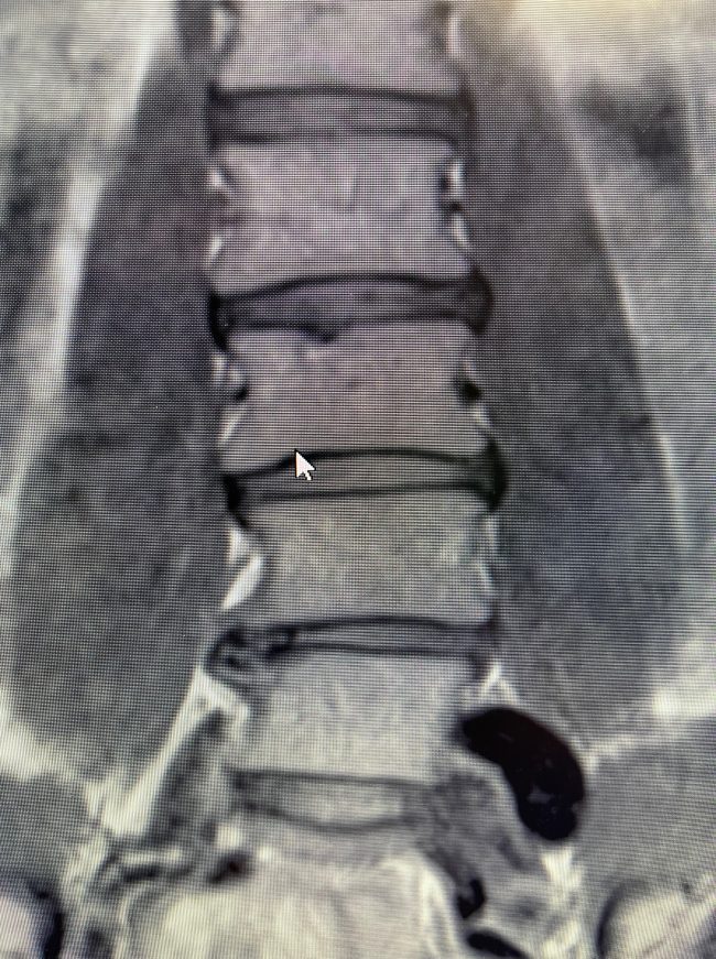 MRI scan showing the lumbar spine with intervertebral discs and vertebrae clearly visible. A cursor is pointing at the third vertebra from the top, a critical spot often addressed in Ring Dinger treatments popular in Seattle, Washington. Sports Medicine Northwest - West Seattle Chiropractic Clinic